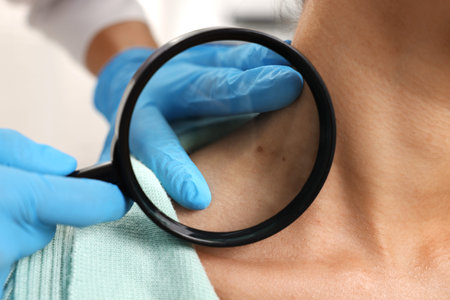 Doctor examining young woman's mole with magnifying glass in hospital, closeup