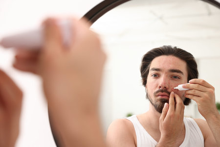 Young man with acne problem applying cream onto his face near mirror at home