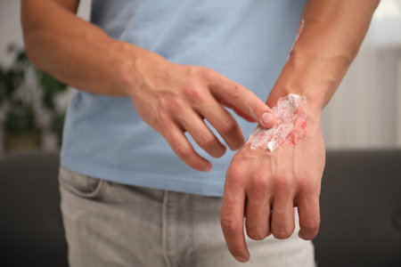 Man applying healing cream onto burned hand at home, closeup