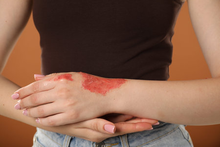 Woman with burned hand on brown background, closeup