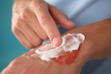 Man applying healing cream onto burned hand on light blue background, closeup