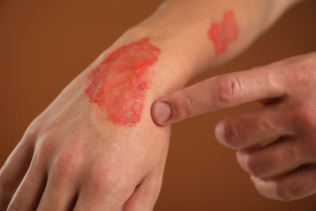 Man with burned hand on brown background, closeup