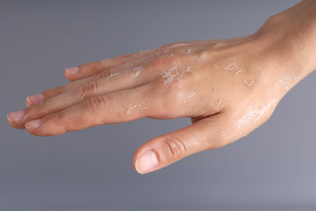 Woman with dry skin on her hand against gray background, closeup