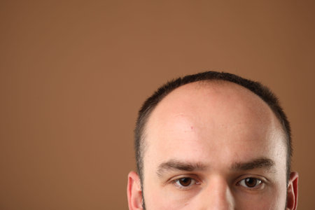 Baldness problem. Man with receding hairline on brown background, closeup. Space for textの写真素材