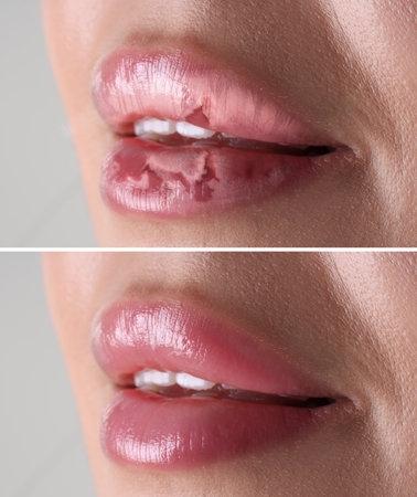Lip care. Woman with chapped and dry skin before and healthy skin after moisturizing treatment, closeup. Collage on gray backgroundの写真素材