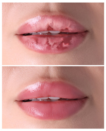 Lip care. Woman with chapped and dry skin before and healthy skin after moisturizing treatment, collageの写真素材