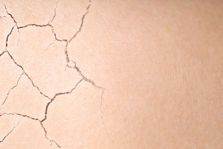 Dry skin presented as double exposure with cracked soilの写真素材