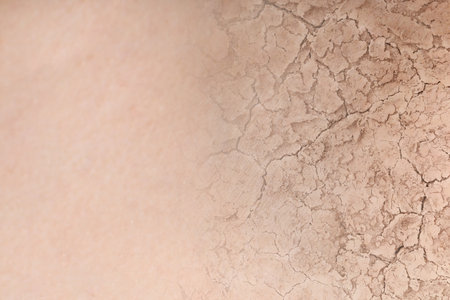 Dry skin presented as double exposure with cracked soilの写真素材