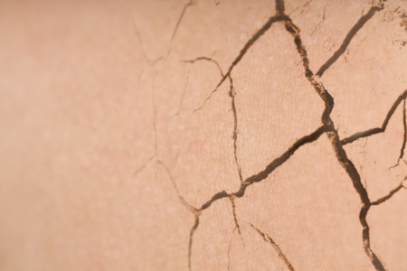 Dry skin presented as double exposure with cracked soilの写真素材