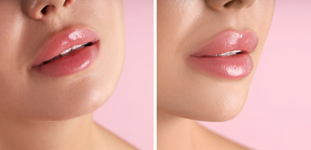 Woman showing her lips before and after cosmetic procedure, closeupの写真素材