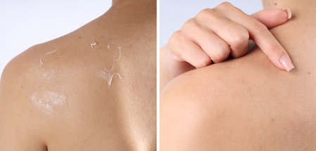 Woman with dry skin before and after moisturizing treatment, closeup. Collage of photosの写真素材