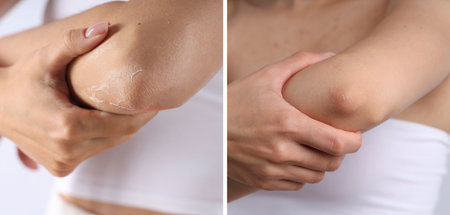 Woman with dry skin on elbow before and after moisturizing treatment, closeup. Collage of photosの写真素材