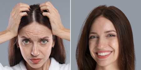 Woman with hair loss problem before and after therapy, closeup. Collage on gray backgroundの写真素材
