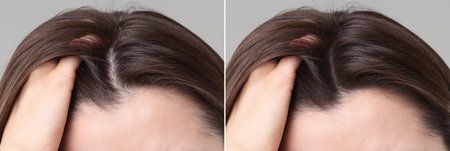 Woman with hair loss problem before and after therapy, closeup. Collage on gray backgroundの写真素材
