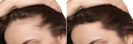 Woman with hair loss problem before and after therapy, closeup. Collageの写真素材