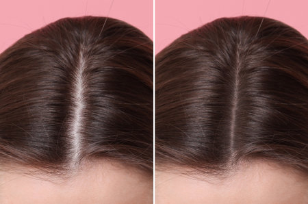 Woman with hair loss problem before and after therapy, closeup. Collage on pink backgroundの写真素材