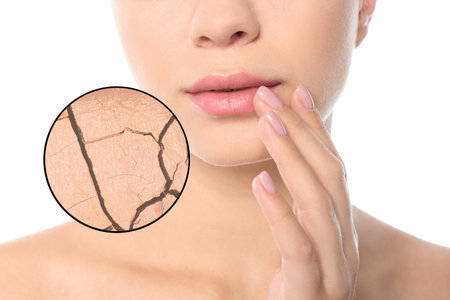 Magnified area of cheek with cracked dry skin. Woman on white background, closeupの写真素材