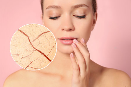 Magnified area of cheek with cracked dry skin. Beautiful woman on pink backgroundの写真素材