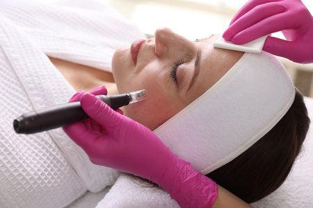 Woman undergoing microneedling procedure in beauty salon, closeup