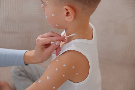 Mother applying cream onto skin of her son with chickenpox at home, closeup