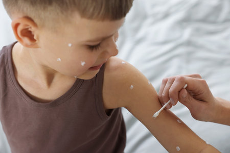 Mother applying cream onto skin of her son with chickenpox at home, closeupの写真素材
