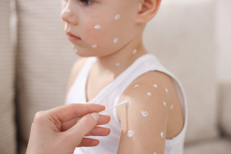 Mother applying cream onto skin of her son with chickenpox at home, closeup