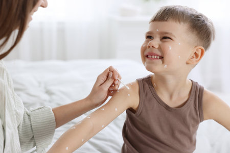 Mother applying cream onto skin of her son with chickenpox at home, closeup