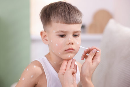 Mother applying cream onto skin of her son with chickenpox at home, closeup