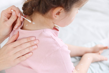 Mother applying cream onto skin of her daughter with chickenpox at home, closeup