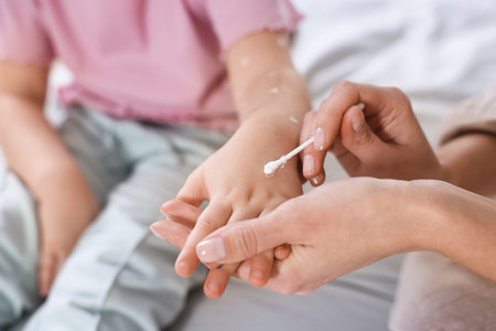 Mother applying cream onto skin of her daughter with chickenpox at home, closeupの写真素材