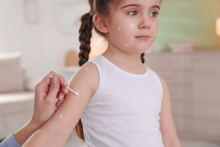 Mother applying cream onto skin of her daughter with chickenpox at home, closeup