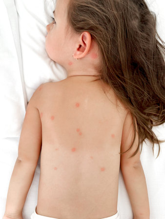 Childs back bitten by mosquitoes. Bite marks on the back. A child bitten by mosquitoes and insects.の写真素材