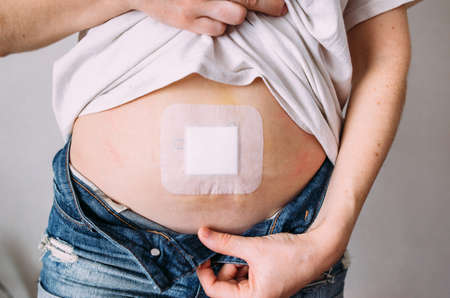 Female belly after a medical operation. Elimination of the umbilical hernia.