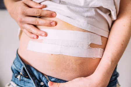 Female belly after a medical operation. Elimination of the umbilical hernia.の写真素材