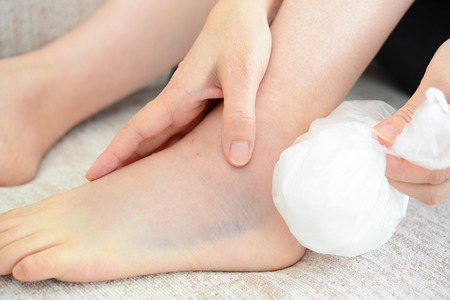 Woman icing a sprained ankle with ice packの写真素材