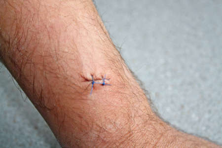 stitches in a mans arm