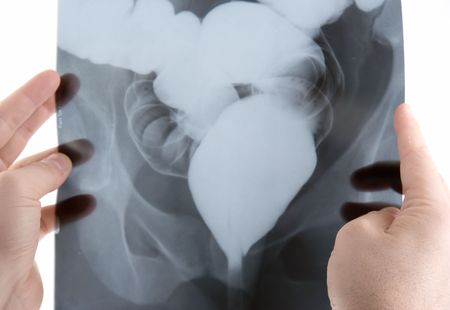 A doctor examining an x-ray scanの写真素材