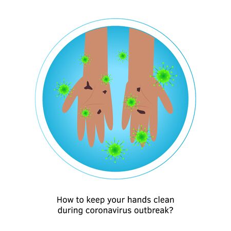 Wash hands infographic. Dirty hands with bacteria holding soap foam under water tap. Arm in foam soap bubbles. Vector illustration flat design. Personal hygiene. Disinfection, skin care. Antibacterialのイラスト素材