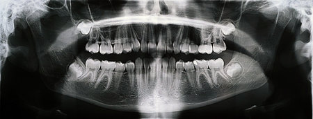 Panoramic X-ray of the jaw. X-ray of the teeth of a 12-year-old girl.