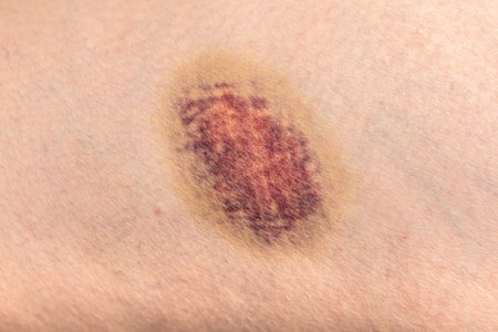 Close up of a bruise on the skin of a man.