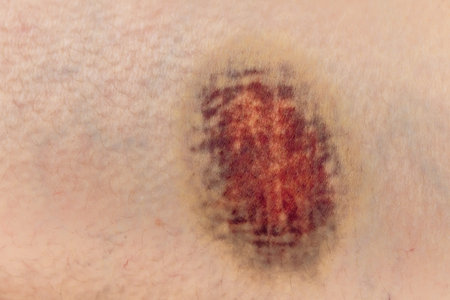 A closeup shot of a bruise on a man's skin