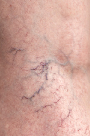 Close-up of varicose veins on a human leg.の写真素材