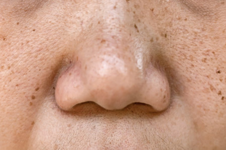 Close up of a man's face with acne and freckles