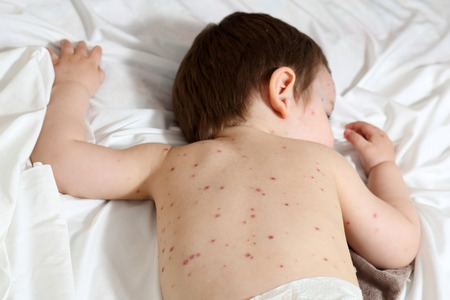 Details of a baby aged 20 months old, he has chickenpox.の写真素材