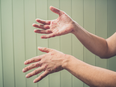 A young man is showing his hands with spots and rash from hand foot and mouth diseaseの写真素材