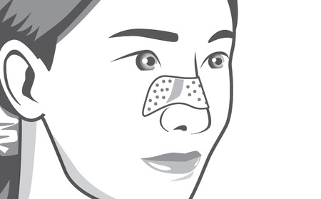 Linear of closeup shot acne pads on women noseのイラスト素材