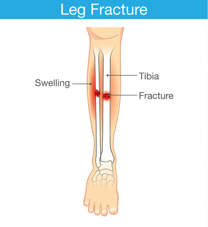 Diagram of leg have bone fracture. This illustration have description of inner leg composition.のイラスト素材