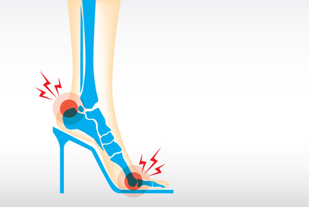 Symptom pain on foot because wearing high heels make heel bone damage and muscles.のイラスト素材