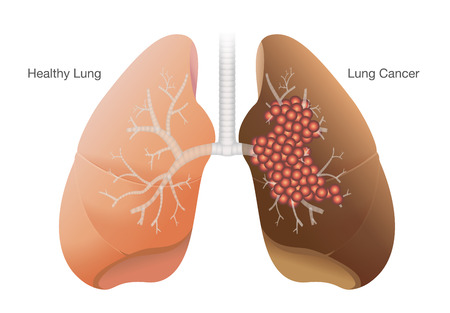 Comparison between healthy lung and cancer lung isolated on white background.のイラスト素材