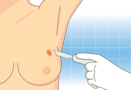 Removal of the breast tumor with surgical to therapy cancer. Medical illustration.のイラスト素材